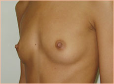 Фото до увеличения груди