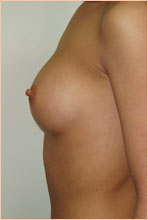 Фото после увеличения груди