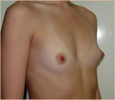 Фото до увеличения груди