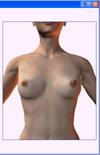 Увеличение груди - подбор имплантантов груди 2