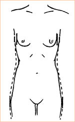 Требуется коррекция груди (увеличение груди)