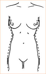 Результаты операции: увеличение и коррекция груди