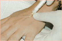 Лечение расширенных вен рук