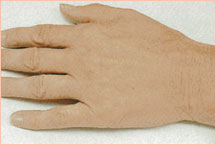 Лечение расширенных вен рук