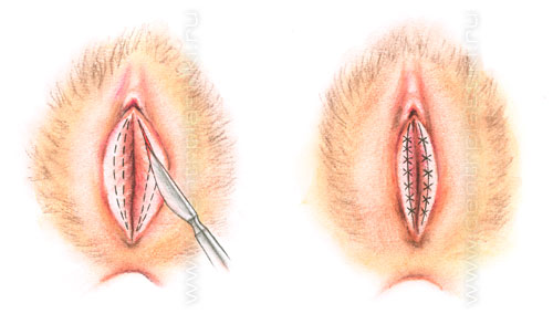 Увеличение малых половых губ после родов