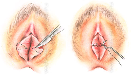 Удаление новообразования малой половой губы (за 1 см2)