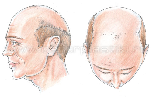 Алопеция (выпадение волос)